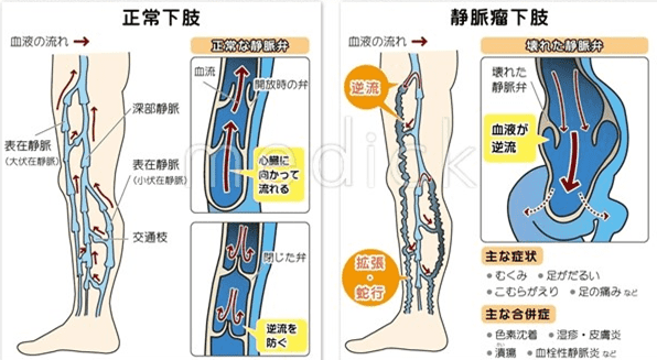 足の表面に浮き出た毛細血管
